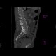 Spondylolysis, spondylolisthesis, lumbar vertebra: CT - Computed tomography
